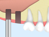 上顎洞の挙上/骨の移植